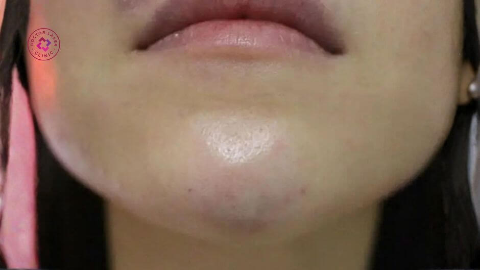 mô căng cứng kém đàn hồi sau tiêm filler