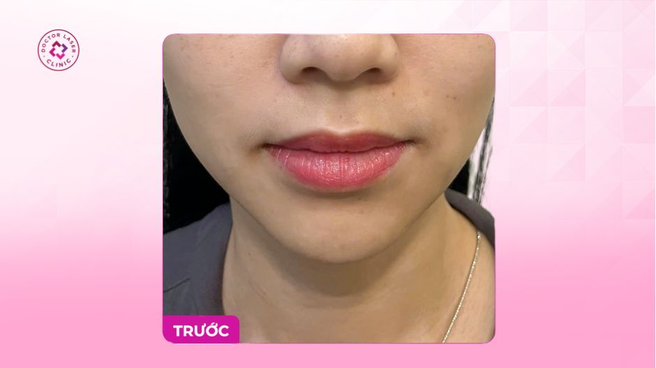 môi nhăn kém sắc trước tiêm filler