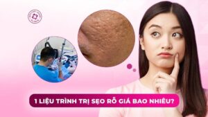 liệu trình điều trị sẹo rỗ giá bao nhiêu liệu trình điều trị sẹo rỗ giá bao nhiêu