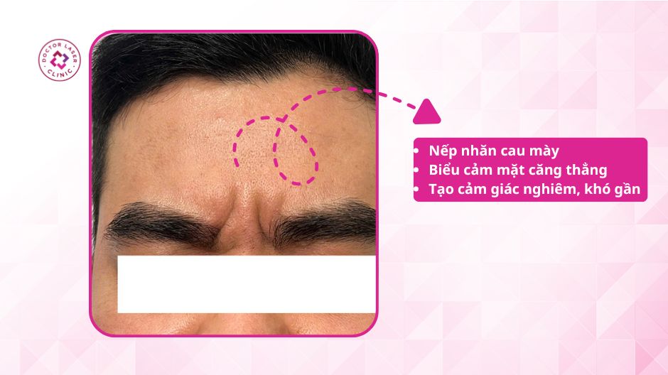 nếp nhăn cau mày nam giới