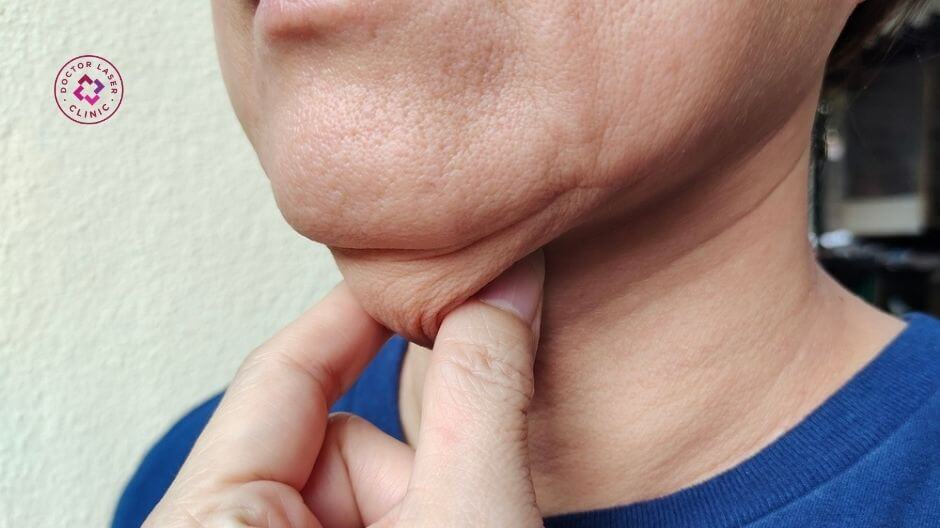 nọng cằm kém thon gọn