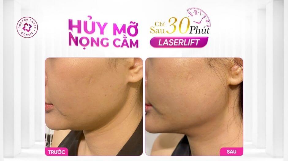 nọng cằm trước sau điều trị laserlift