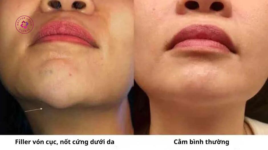 nốt cứng dưới da do filler