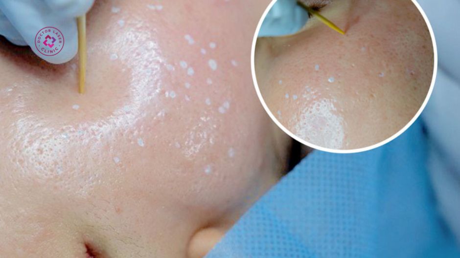 phương pháp chấm tca