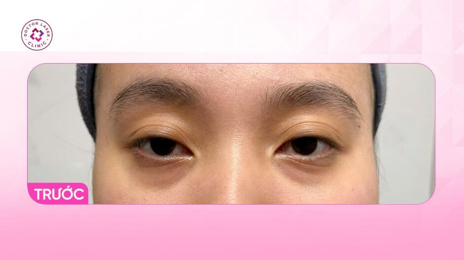 quầng thâm mắt trước khi điều trị