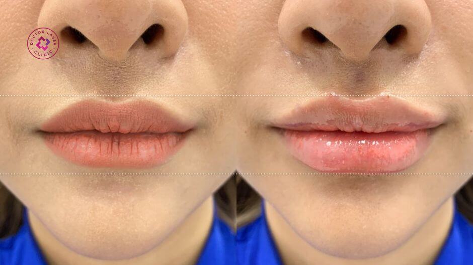 quy trình tiêm filler môi cherry chuẩn y khoa