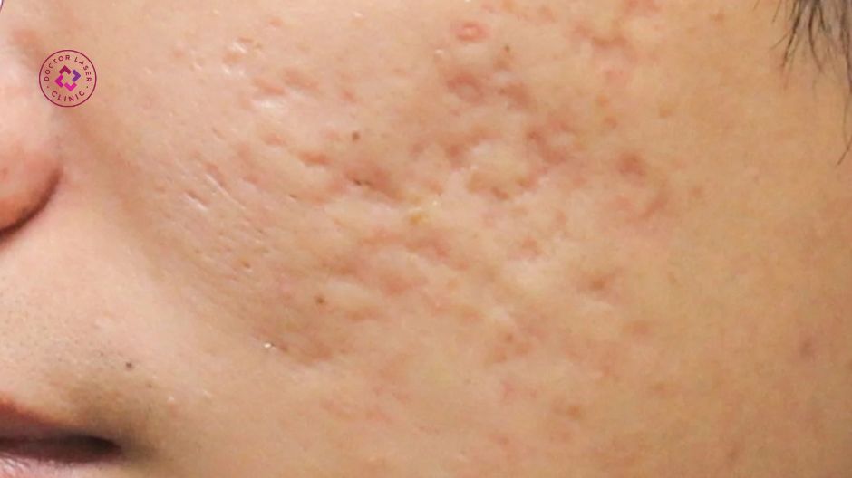 sẹo rỗ chân vuông