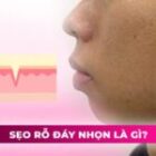 Sẹo rỗ đáy nhọn là gì? Nguyên nhân, dấu hiệu và cách điều trị