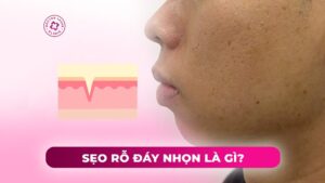 sẹo rỗ đáy nhọn là gì