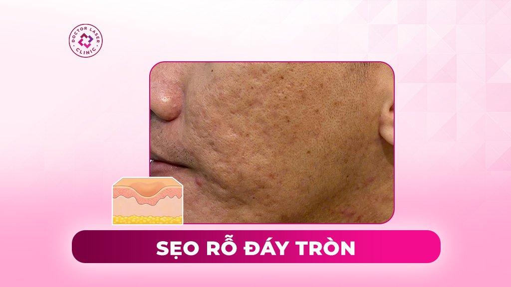 sẹo rỗ đáy tròn là gì