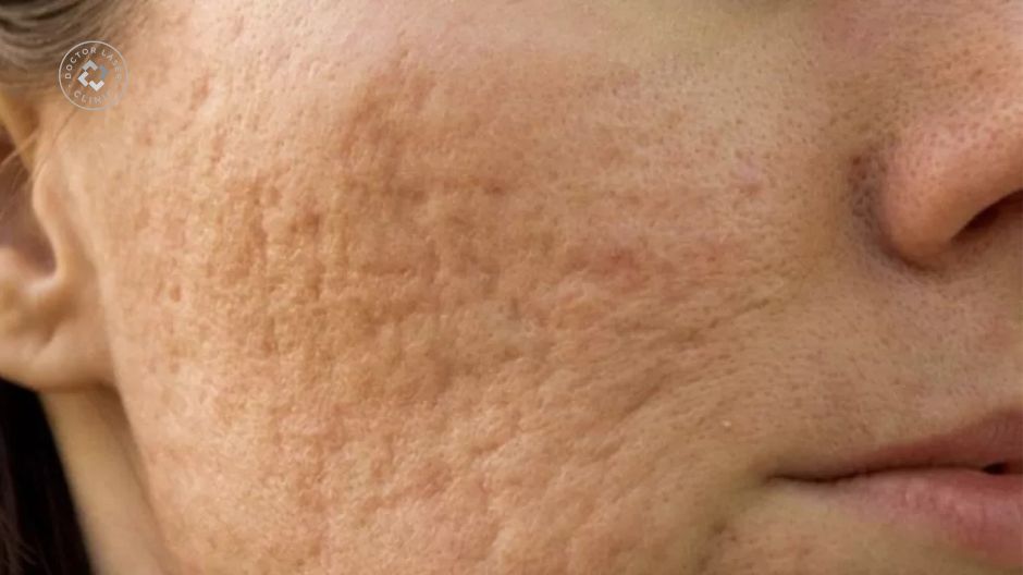 sẹo rỗ đáy tròn