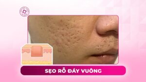 sẹo rỗ đáy vuông