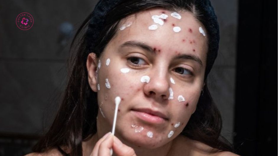 sẹo rỗ sau thủy đậu ở mũi