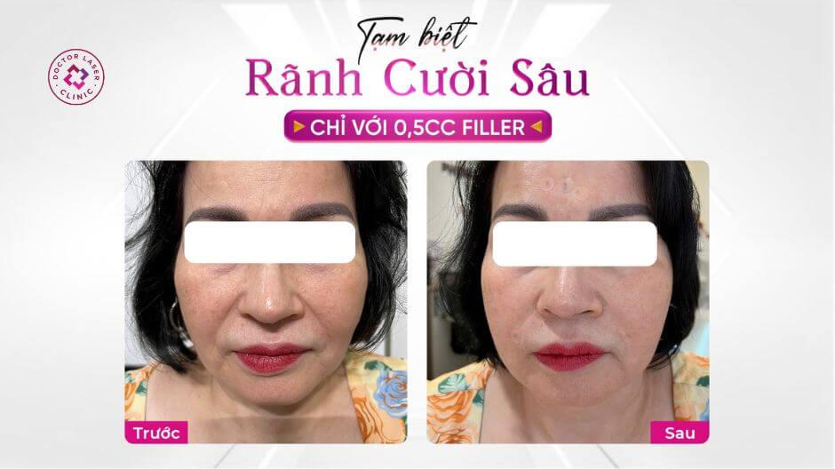 so sánh trước sau filler rãnh cười