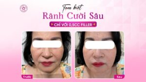 Giảm rãnh cười sâu, lấy lại tự tin nhờ tiêm filler