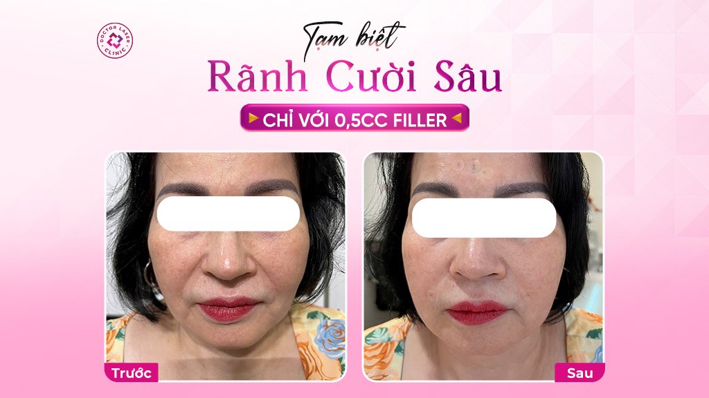 tạm biệt rãnh cười sâu
