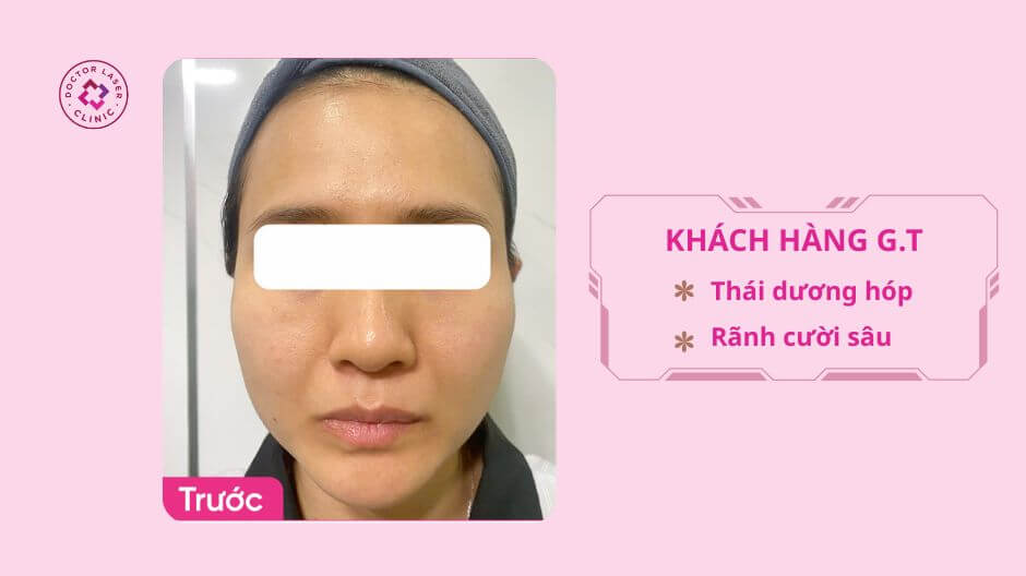 thiếu hụt thể tích thái dương rãnh cười trước điều trị