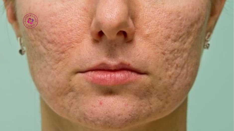 thời gian liệu trình dựa vào mức độ sẹo