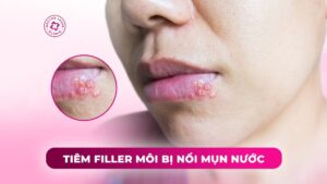 tiêm filler môi bị nổi mụn nước