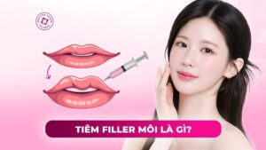 tiêm filler môi là gì