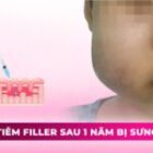 Tiêm filler sau 1 năm bị sưng có nguy hiểm không? Cách xử lý