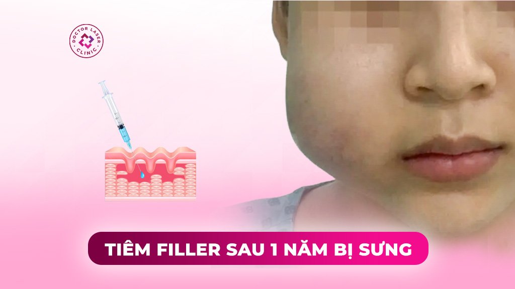 tiêm filler sau 1 năm bị sưng