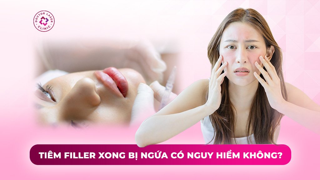 tiêm filler xong bị ngứa