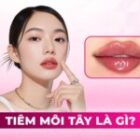 Tiêm môi tây là gì? Ưu điểm, chỉ định và quy trình thực hiện