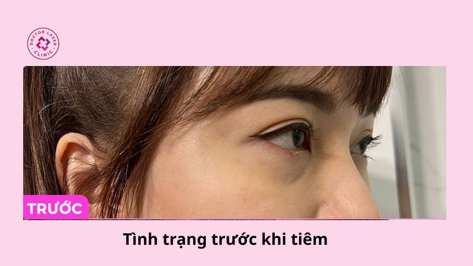 tình trạng hõm mắt trước khi tiêm filler