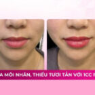 Trẻ hoá môi nhăn, thiếu tươi tắn với filler