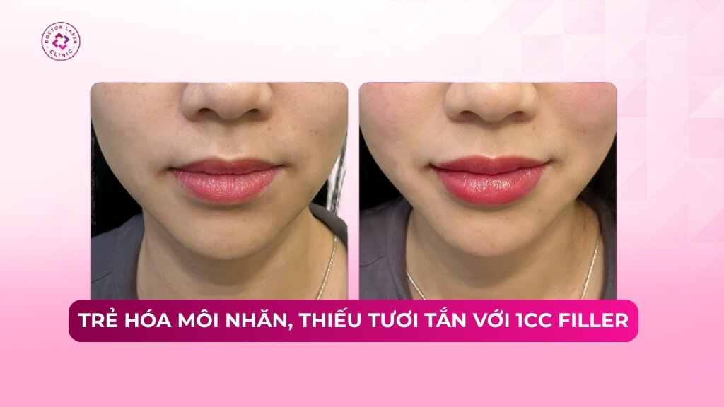 trẻ hoá môi nhăn thiếu tươi tắn với 1cc filler