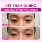 Trẻ hoá, xoá quầng thâm tự nhiên tại Doctor Laser