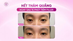 trẻ hoá xoá quầng thâm mắt với filler