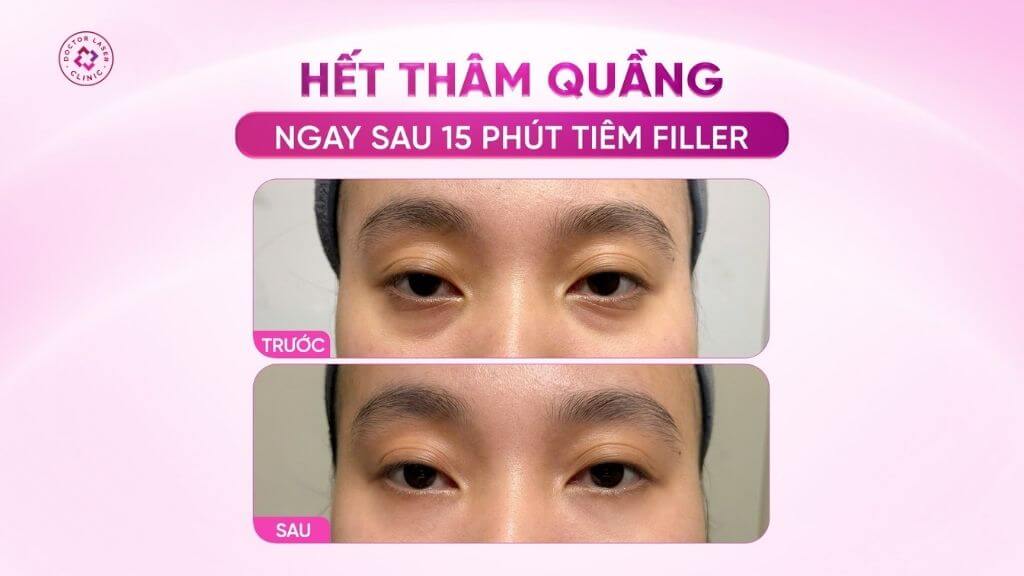 trẻ hoá xoá quầng thâm mắt với filler