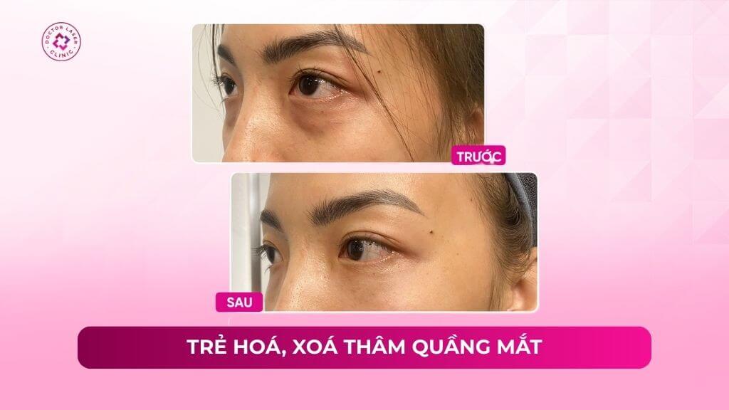 trẻ hoá xoá thâm quầng mắt