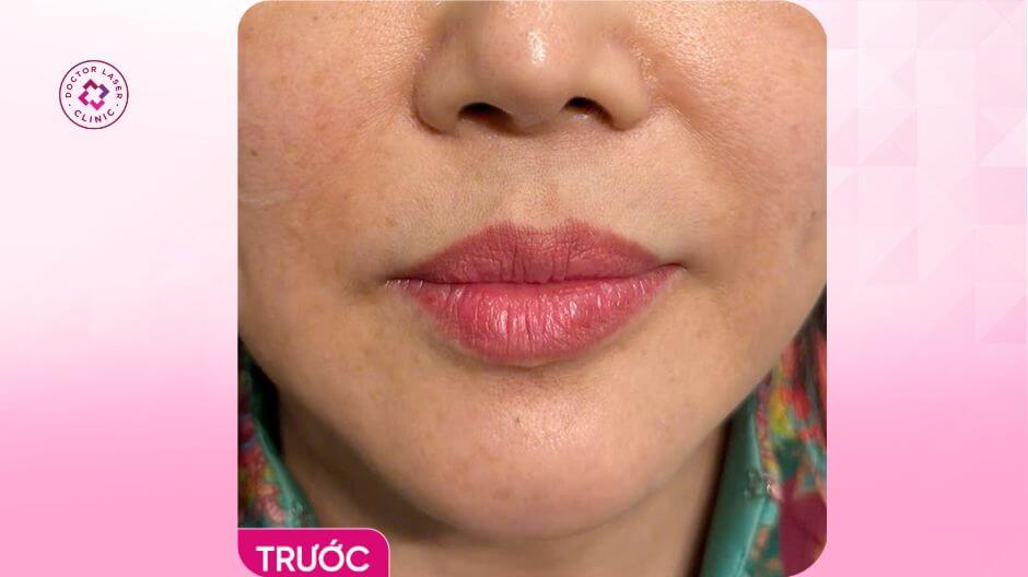 trước điều trị môi lệch