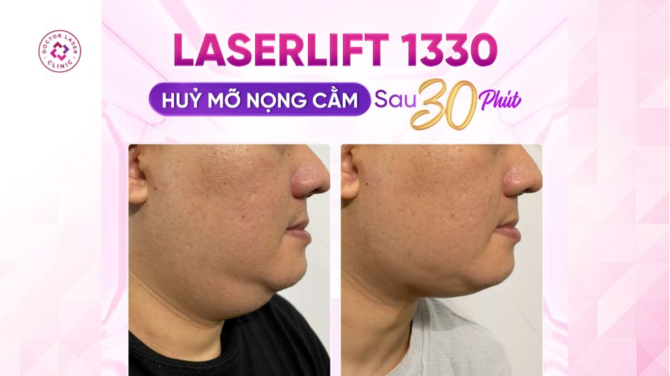 trước sau laserlift 1330 giảm mỡ nọng cằm