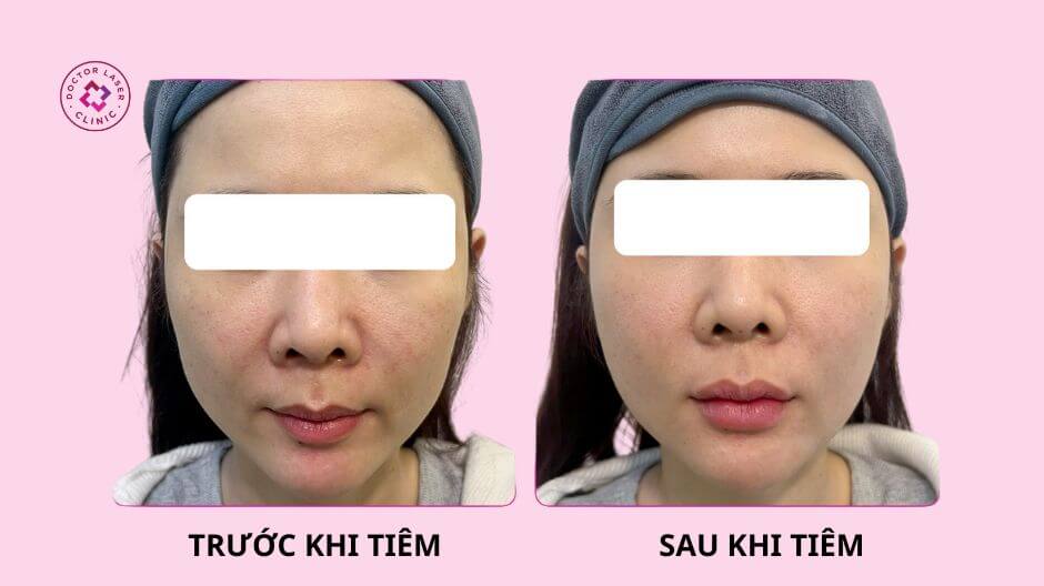trước sau tiêm filler má baby tự nhiên
