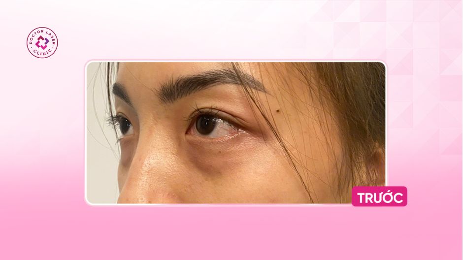 trước khi tiêm filler hõm mắt quầng thâm