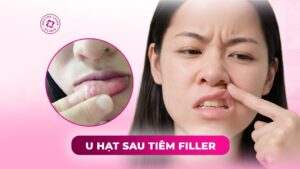 u hạt sau tiêm filler