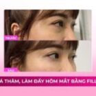 Xóa thâm, làm đầy hõm mắt sau tiêm filler