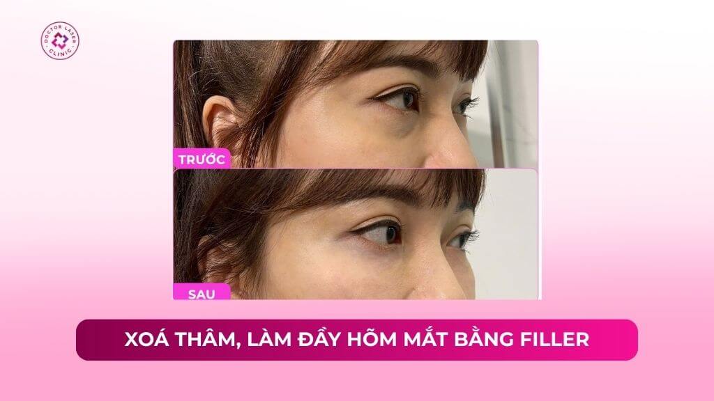 xoá thâm làm đầy hõm mắt bằng filler