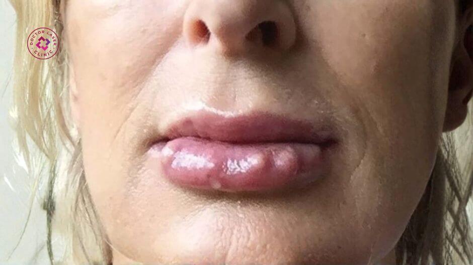 xuất hiện hạt cục nhỏ đướia sau tiêm filler