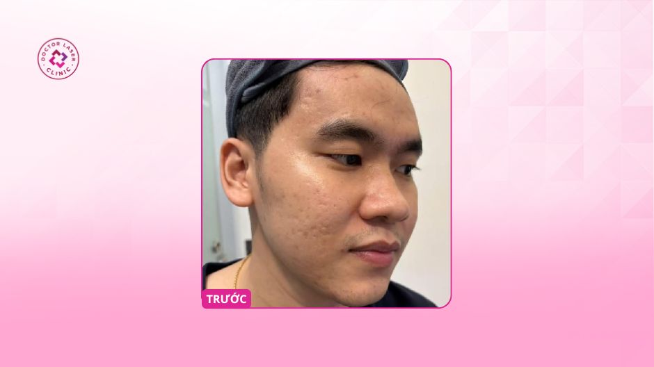 anh th trước điều trị sẹo rỗ lâu năm 8 năm