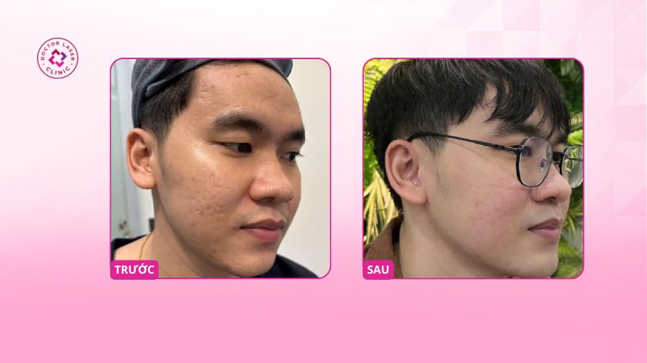 anh th trước sau điều trị sẹo rỗ lâu năm