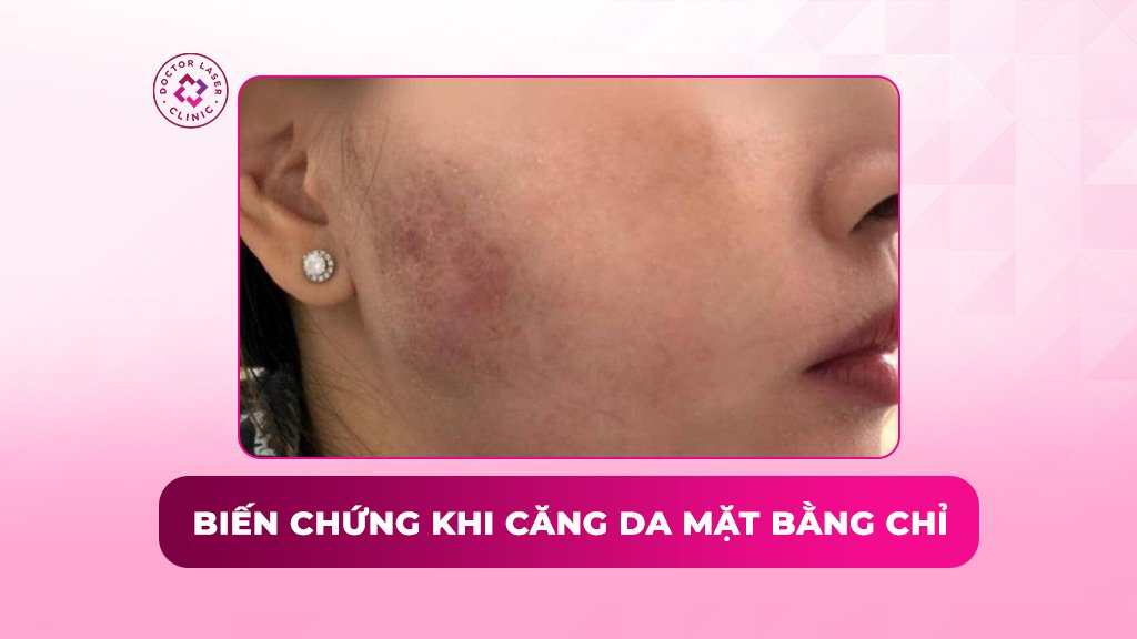 7 biến chứng khi căng da mặt bằng chỉ và hướng dẫn xử lý