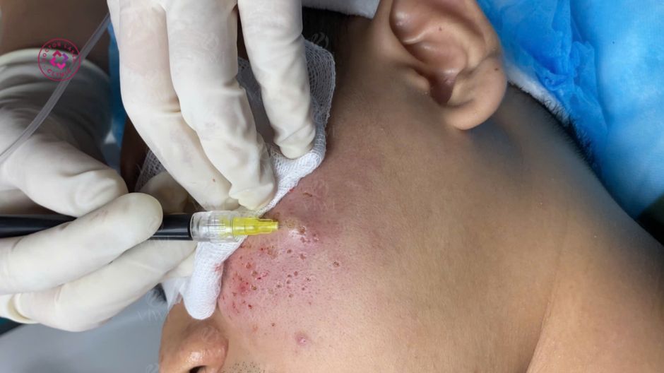 bóc tách đáy sẹo giải phóng mô xơ vùng trán