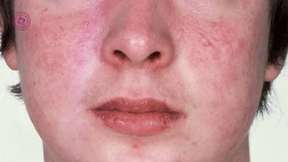 bỏng lạnh do chườm đá sau tiêm filler