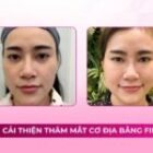 Cải thiện thâm mắt cơ địa bằng filler
