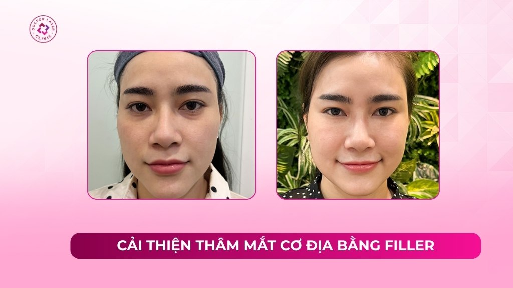 Cải thiện thâm mắt cơ địa bằng filler